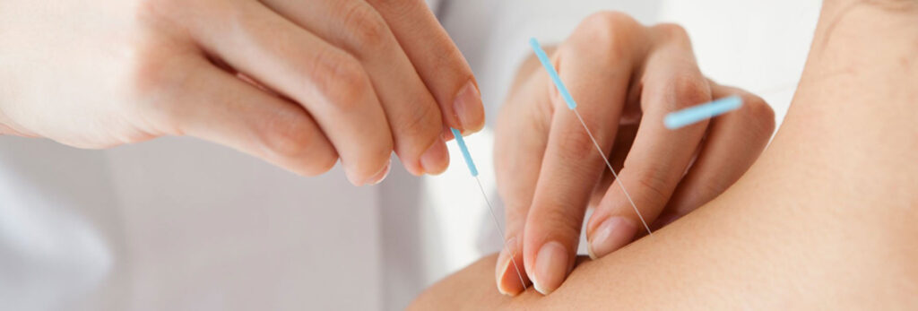 Benefits of Acupuncture in Pain Management