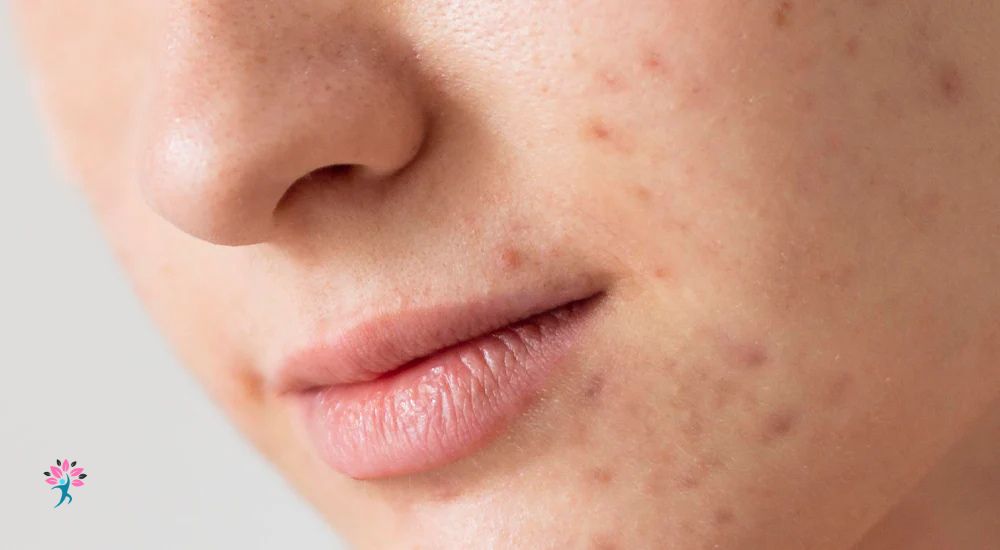 How to Prevent Acne with Proper Hygiene