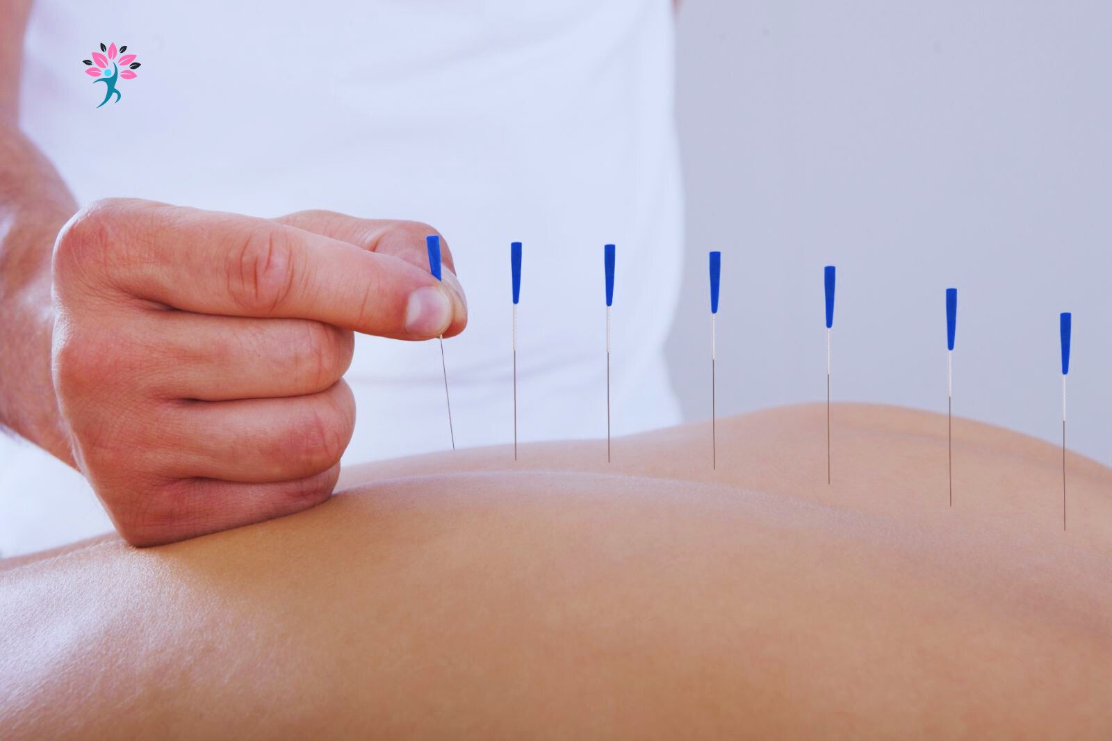 The Role of Acupuncture in Pain Management