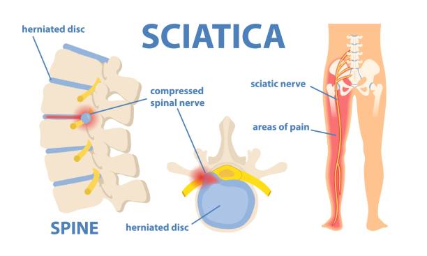 Illustration of sciatica pain, showing the compressed spinal nerve, herniated disc, and affected areas along the sciatic nerve pathway.