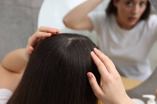 A woman examining her scalp in the mirror, noticing signs of dandruff and poor scalp hygiene, emphasizing the need to avoid dandruff with proper hair care.