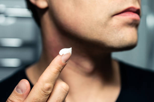 A man applying soothing cream to his neck to prevent razor bumps and irritation after shaving.