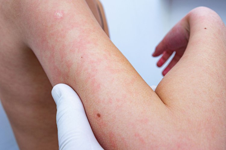 Heat Rash Prevention venzec