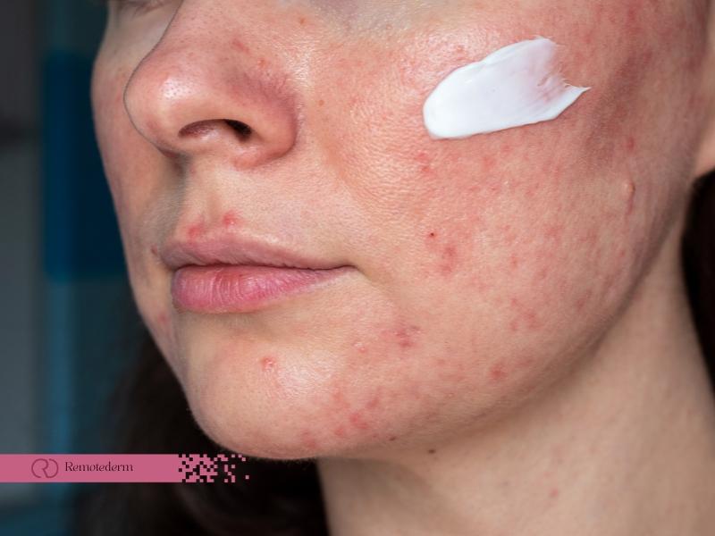 Rosacea Skincare: What You Need to Know venzec