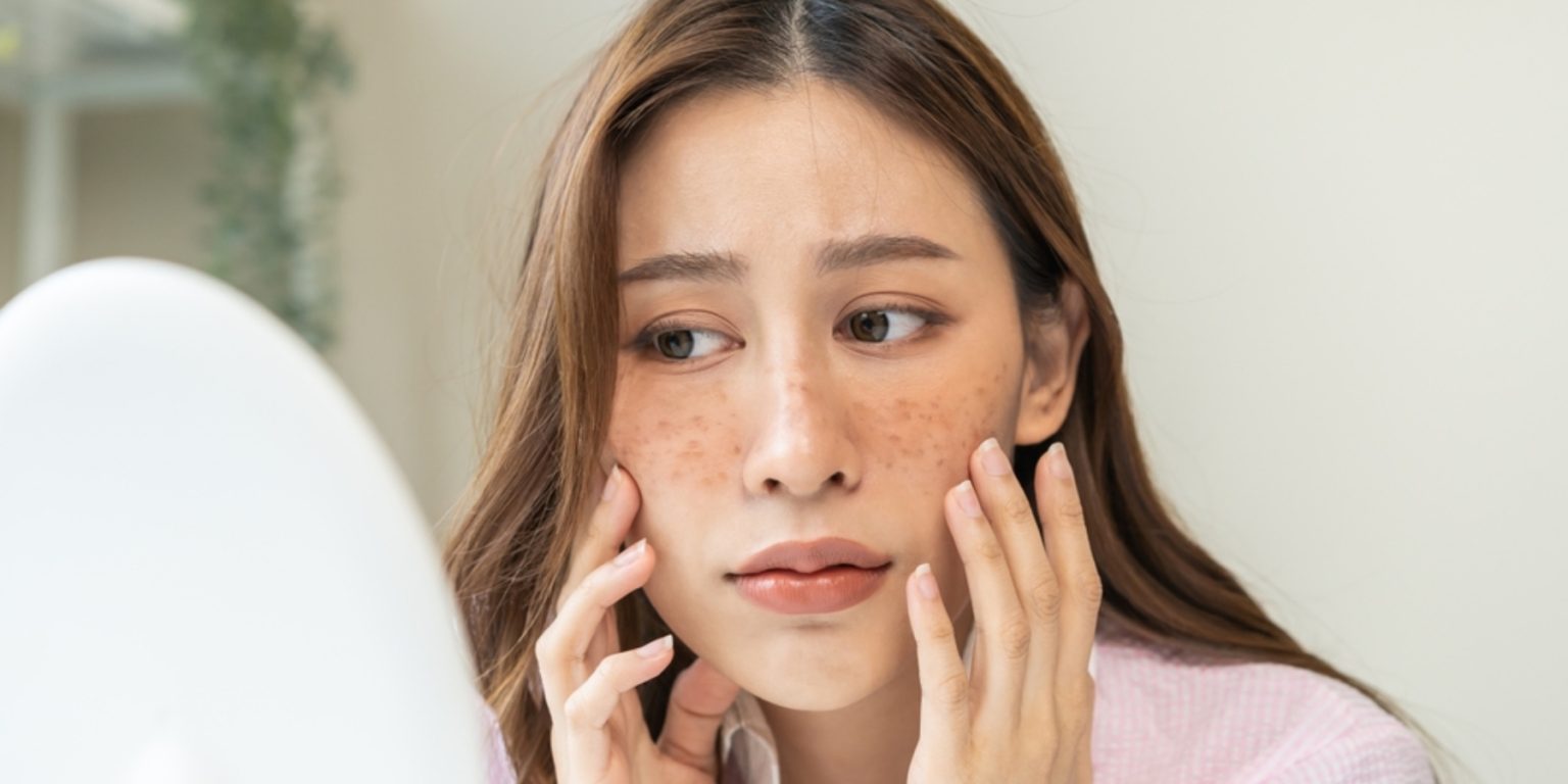melasma, summer skincare, sun protection,
